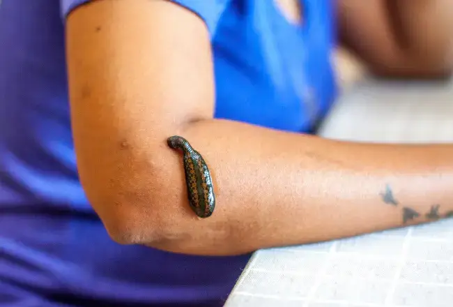 Worms Removing from Arm